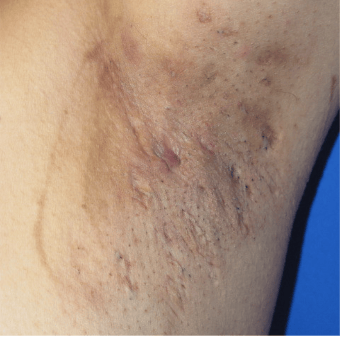 Thumbnail of the Ejemplo de hidradenitis supurativa image
